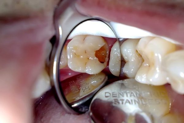 Cara Mengatasi Rasa Sakit Akibat Gigi Berlubang Puri Dental Clinic