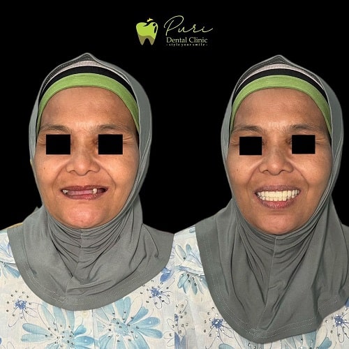Pemasangan Gigi Palsu
