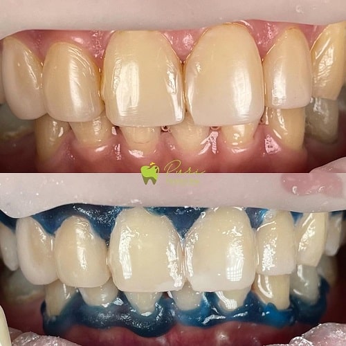 Pemutihan Gigi Bleaching