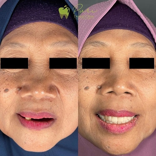 Gigi Palsu Valplast